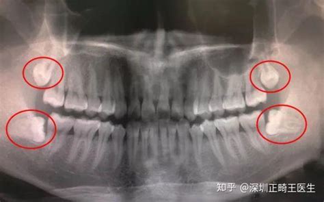 牙齒拔掉|3种方法来拔牙